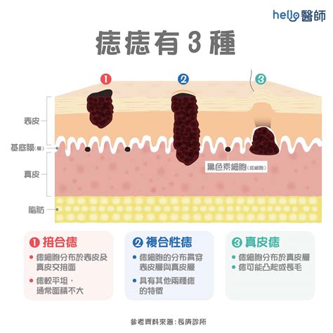 痣 斑|痣變大、痣多或長毛會變皮膚癌？認識痣的形成與原因